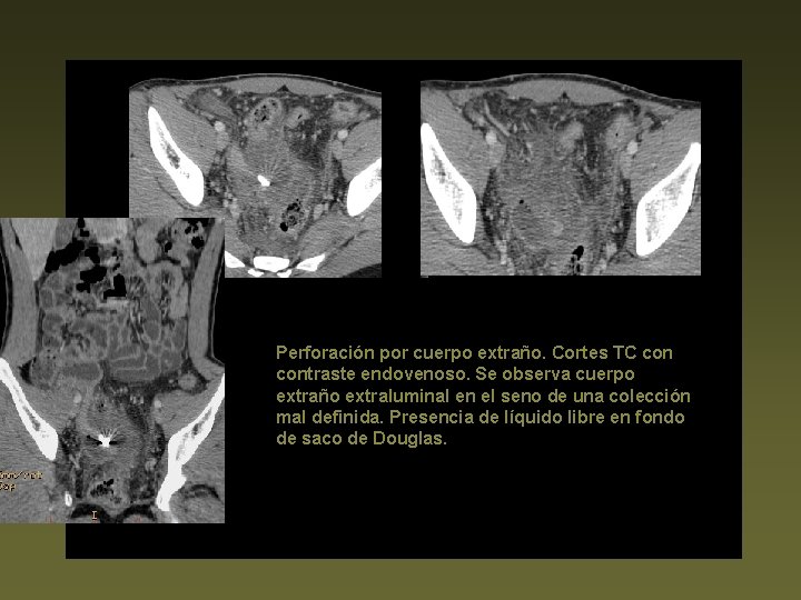 Perforación por cuerpo extraño. Cortes TC contraste endovenoso. Se observa cuerpo extraño extraluminal en