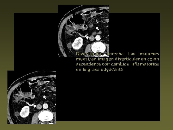 Diverticulitis derecha. Las imágenes muestran imagen diverticular en colon ascendente con cambios inflamatorios en