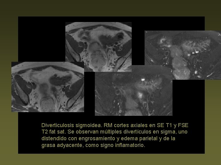Diverticulosis sigmoidea. RM cortes axiales en SE T 1 y FSE T 2 fat
