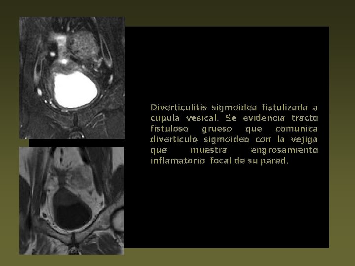 Diverticulitis sigmoidea fistulizada a cúpula vesical. Se evidencia tracto fistuloso grueso que comunica diverticulo