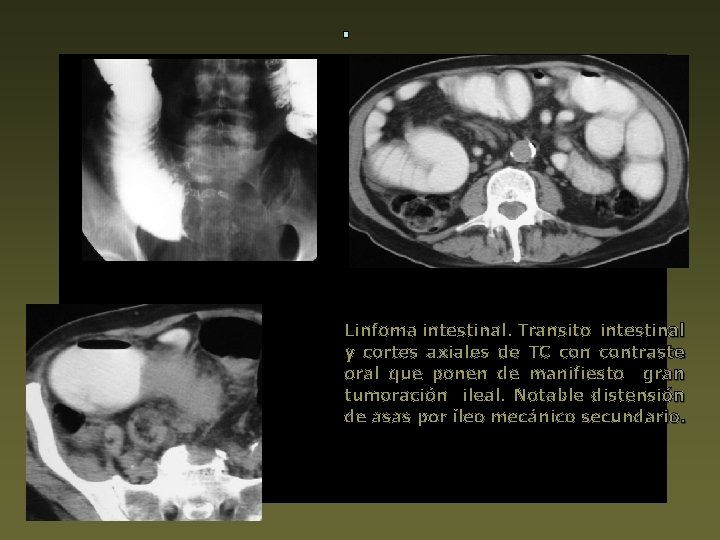 Linfoma intestinal. Transito intestinal y cortes axiales de TC contraste oral que ponen de