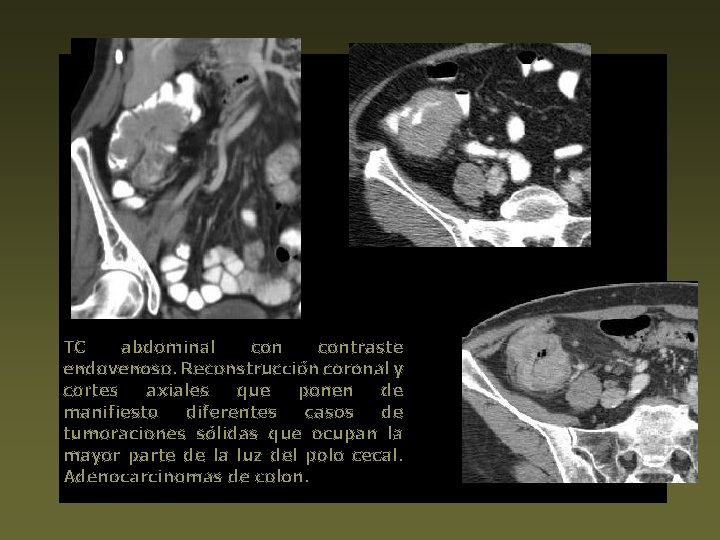 TC abdominal contraste endovenoso. Reconstrucción coronal y cortes axiales que ponen de manifiesto diferentes