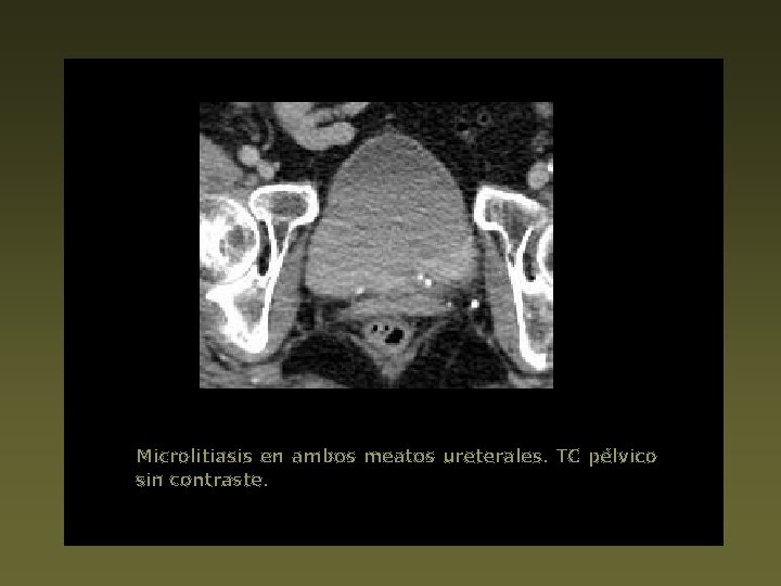 Microlitiasis en ambos meatos ureterales. TC pélvico sin contraste. 