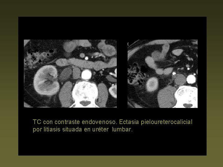 TC contraste endovenoso. Ectasia pieloureterocalicial por litiasis situada en uréter lumbar. 