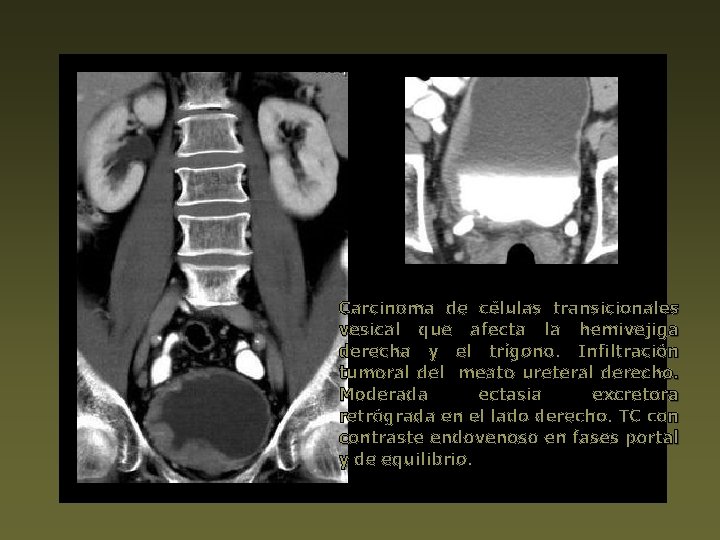 Carcinoma de células transicionales vesical que afecta la hemivejiga derecha y el trígono. Infiltración