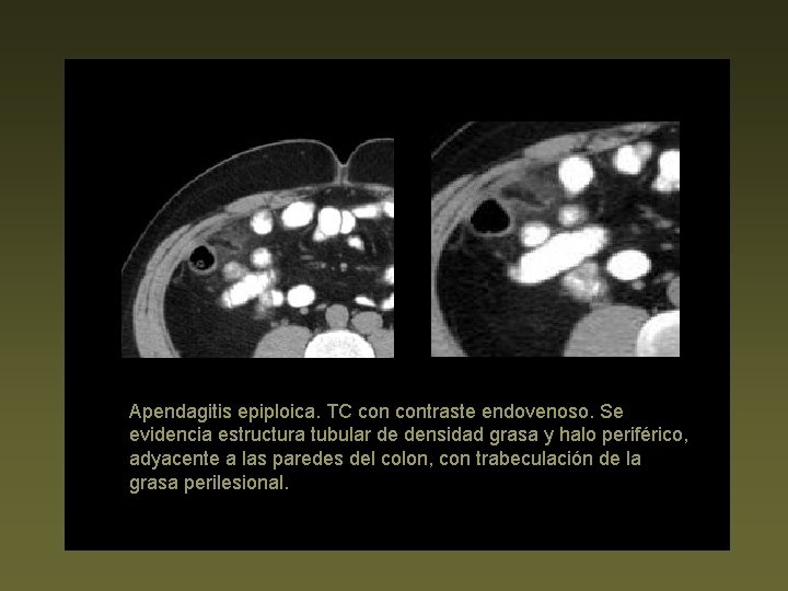 Apendagitis epiploica. TC contraste endovenoso. Se evidencia estructura tubular de densidad grasa y halo