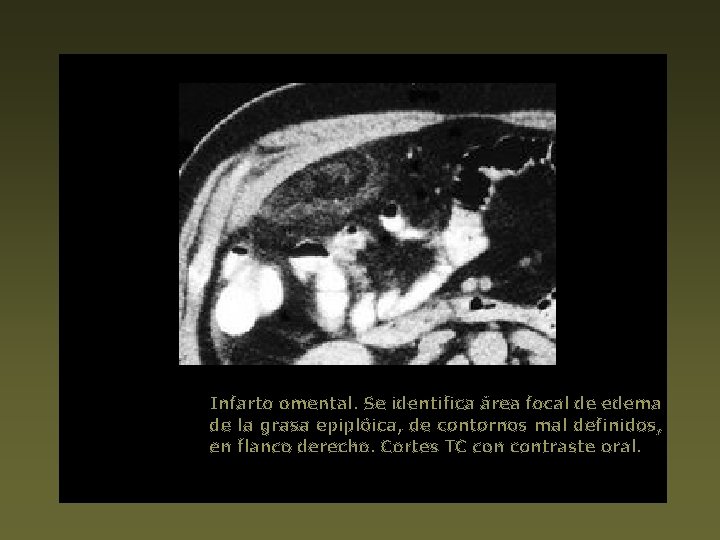 Infarto omental. Se identifica área focal de edema de la grasa epiplóica, de contornos