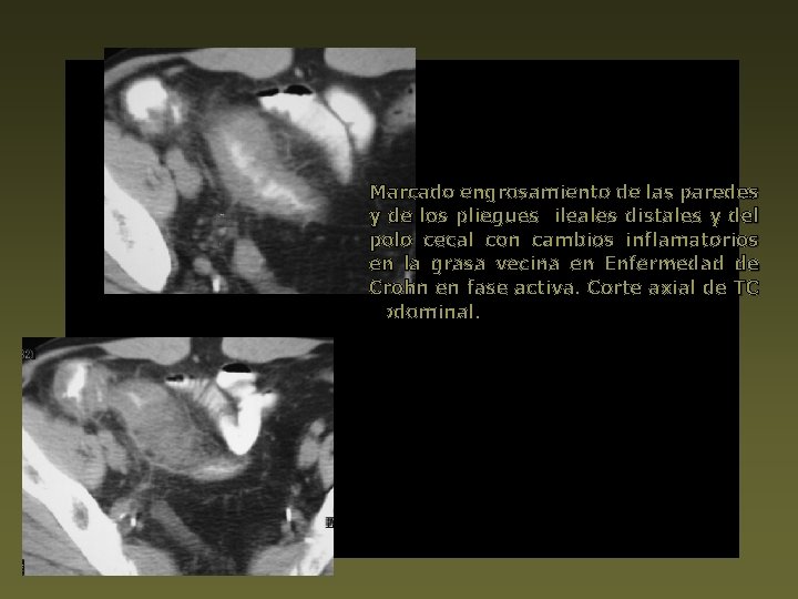 Marcado engrosamiento de las paredes y de los pliegues ileales distales y del polo