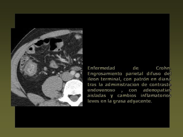 Enfermedad de Crohn. Engrosamiento parietal difuso del ileon terminal, con patrón en diana tras