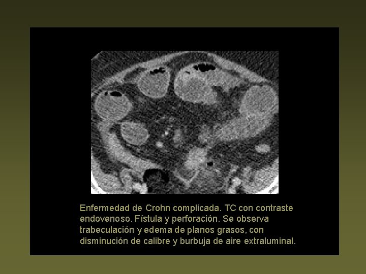 Enfermedad de Crohn complicada. TC contraste endovenoso. Fístula y perforación. Se observa trabeculación y
