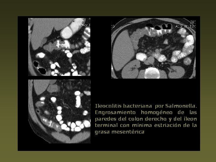 Ileocolitis bacteriana por Salmonella. Engrosamiento homogéneo de las paredes del colon derecho y del