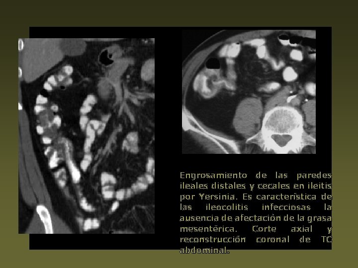 Engrosamiento de las paredes ileales distales y cecales en ileitis por Yersinia. Es característica