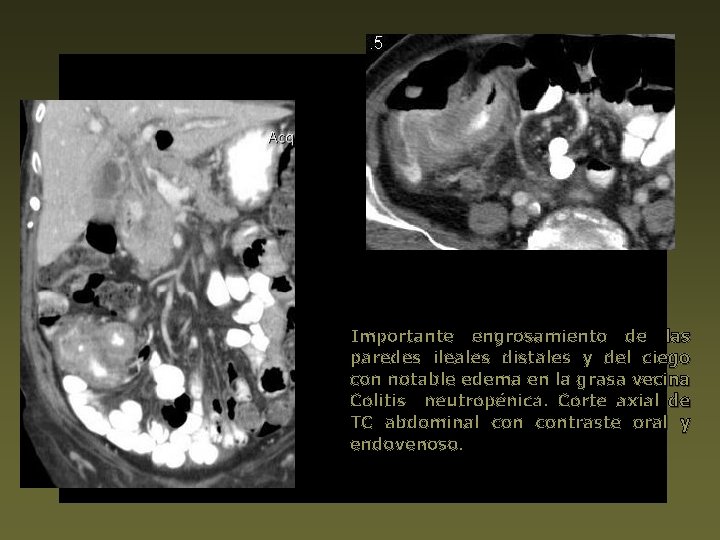 Importante engrosamiento de las paredes ileales distales y del ciego con notable edema en