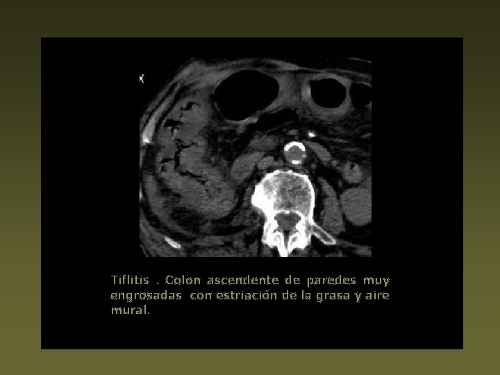 Tiflitis . Colon ascendente de paredes muy engrosadas con estriación de la grasa y