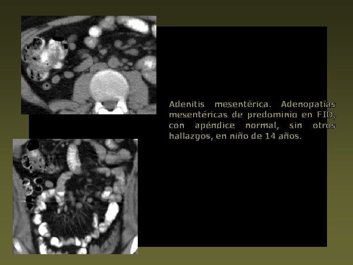 Adenitis mesentérica. Adenopatías mesentéricas de predominio en FID, con apéndice normal, sin otros hallazgos,