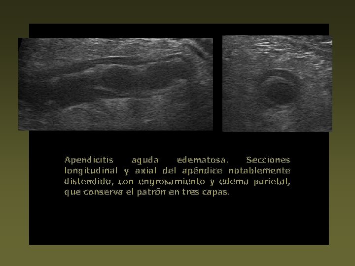 Apendicitis aguda edematosa. Secciones longitudinal y axial del apéndice notablemente distendido, con engrosamiento y