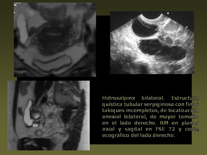 Hidrosalpinx bilateral. Estructura quística tubular serpiginosa con finos tabiques incompletos, de localización anexial bilateral,