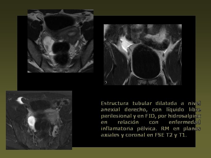 Estructura tubular dilatada a nivel anexial derecho, con líquido libre perilesional y en FID,