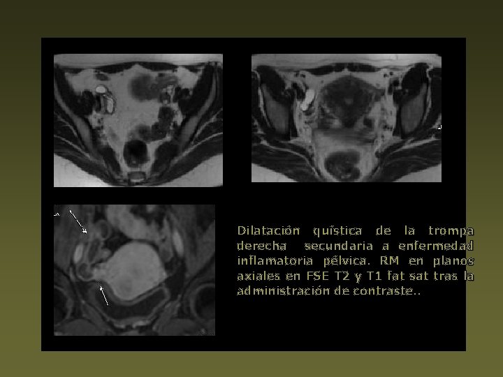 Dilatación quística de la trompa derecha secundaria a enfermedad inflamatoria pélvica. RM en planos
