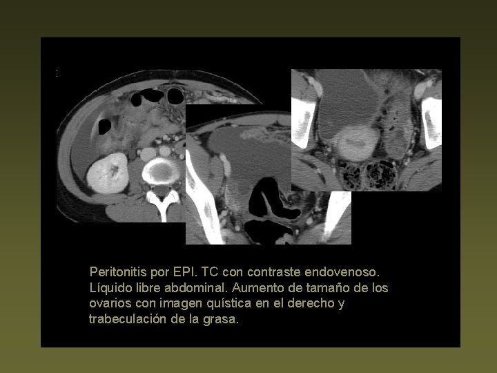 Peritonitis por EPI. TC contraste endovenoso. Líquido libre abdominal. Aumento de tamaño de los