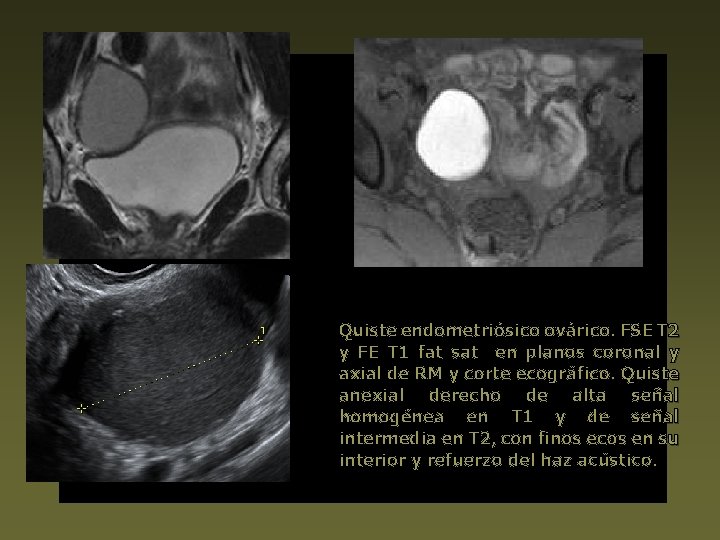 Quiste endometriósico ovárico. FSE T 2 y FE T 1 fat sat en planos