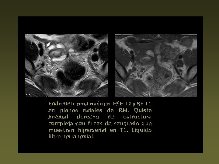 Endometrioma ovárico. FSE T 2 y SE T 1 en planos axiales de RM.