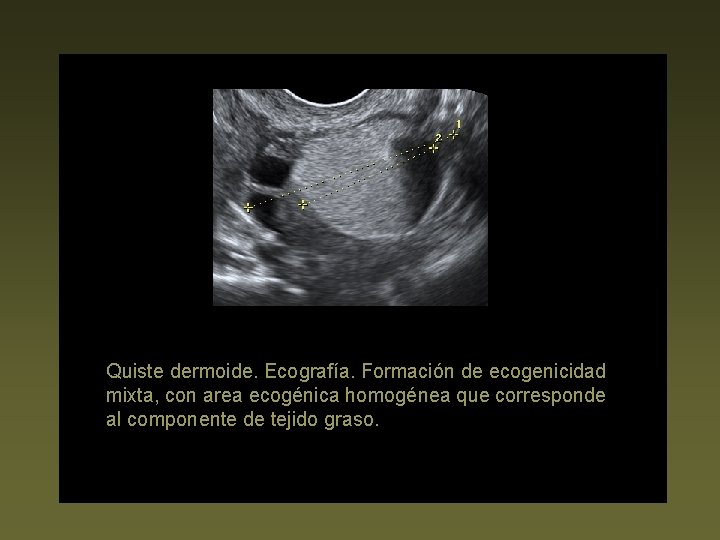 Quiste dermoide. Ecografía. Formación de ecogenicidad mixta, con area ecogénica homogénea que corresponde al