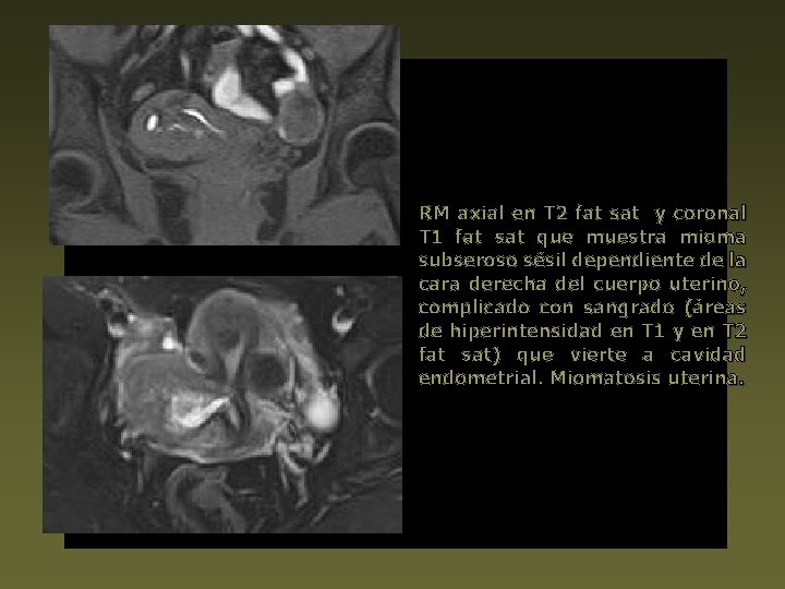 RM axial en T 2 fat sat y coronal T 1 fat sat que