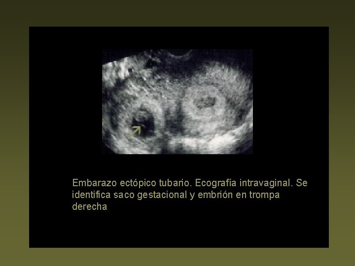 Embarazo ectópico tubario. Ecografía intravaginal. Se identifica saco gestacional y embrión en trompa derecha.