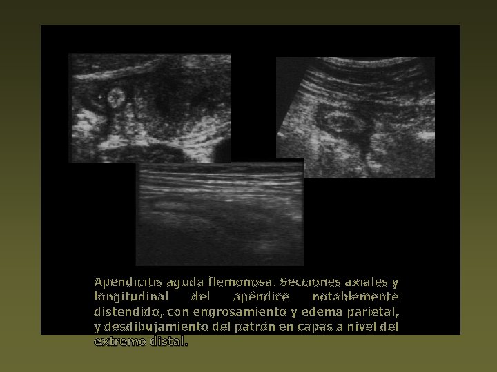 Apendicitis aguda flemonosa. Secciones axiales y longitudinal del apéndice notablemente distendido, con engrosamiento y