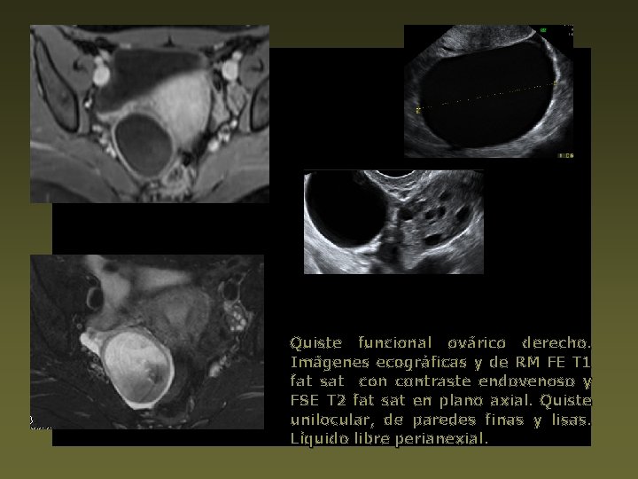 Quiste funcional ovárico derecho. Imágenes ecográficas y de RM FE T 1 fat sat
