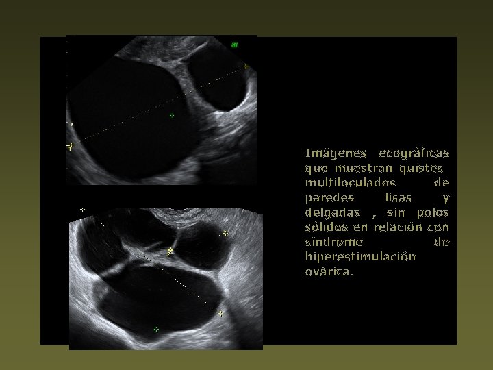 Imágenes ecográficas que muestran quistes multiloculados de paredes lisas y delgadas , sin polos