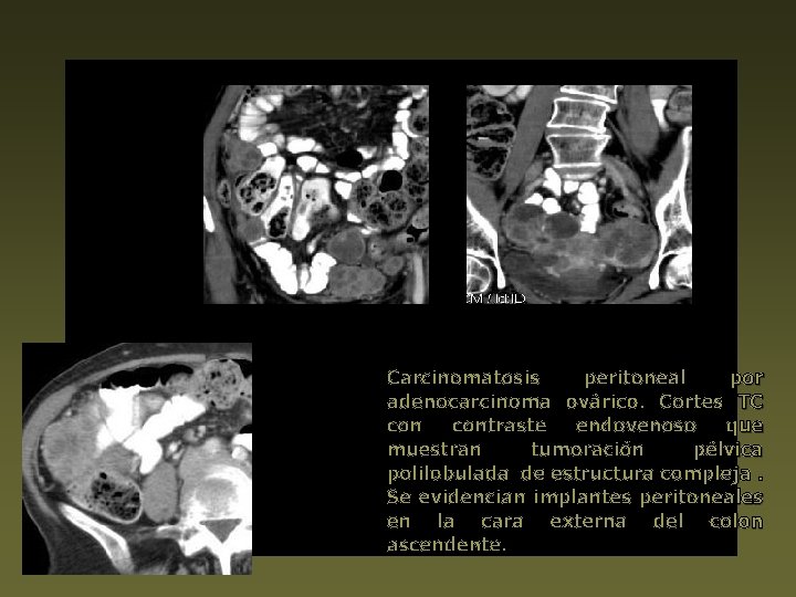 Carcinomatosis peritoneal por adenocarcinoma ovárico. Cortes TC contraste endovenoso que muestran tumoración pélvica polilobulada