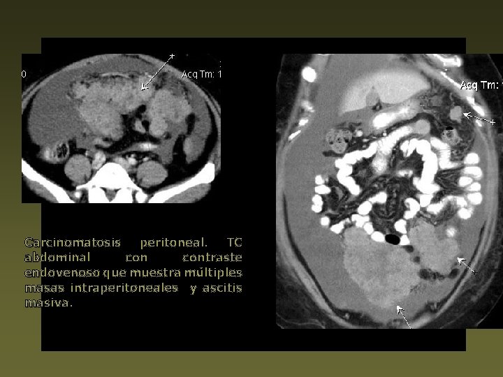 Carcinomatosis peritoneal. TC abdominal contraste endovenoso que muestra múltiples masas intraperitoneales y ascitis masiva.