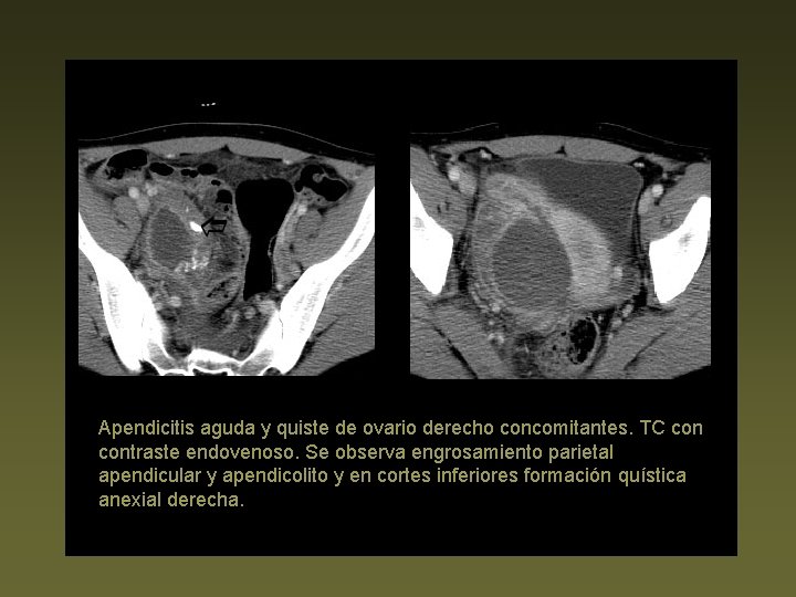 Apendicitis aguda y quiste de ovario derecho concomitantes. TC contraste endovenoso. Se observa engrosamiento