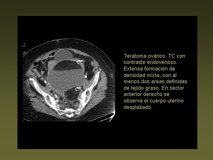 Teratoma ovárico. TC contraste endovenoso. Extensa formación de densidad mixta, con al menos dos