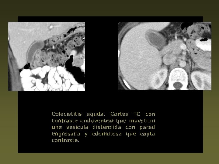 Colecistitis aguda. Cortes TC contraste endovenoso que muestran una vesícula distendida con pared engrosada