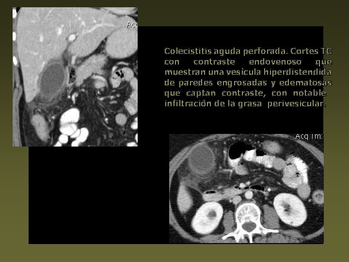 Colecistitis aguda perforada. Cortes TC contraste endovenoso que muestran una vesícula hiperdistendida de paredes