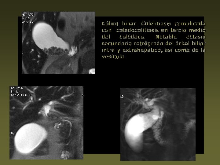 Cólico biliar. Colelitiasis complicada con coledocolitiasis en tercio medio del colédoco. Notable ectasia secundaria