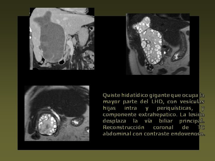 Quiste hidatídico gigante que ocupa la mayor parte del LHD, con vesículas hijas intra