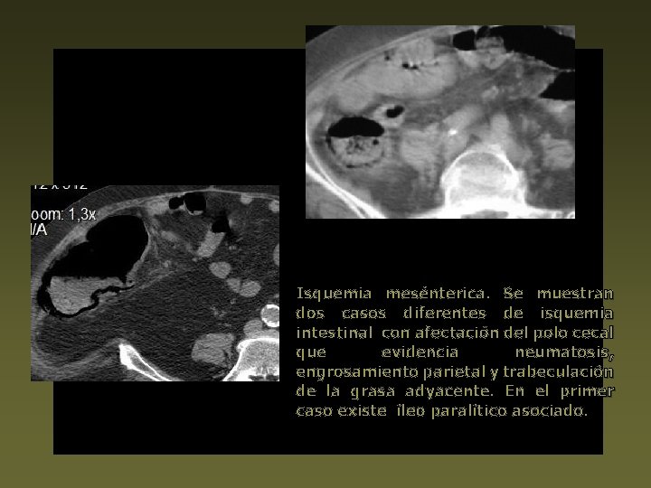 Isquemia mesénterica. Se muestran dos casos diferentes de isquemia intestinal con afectación del polo