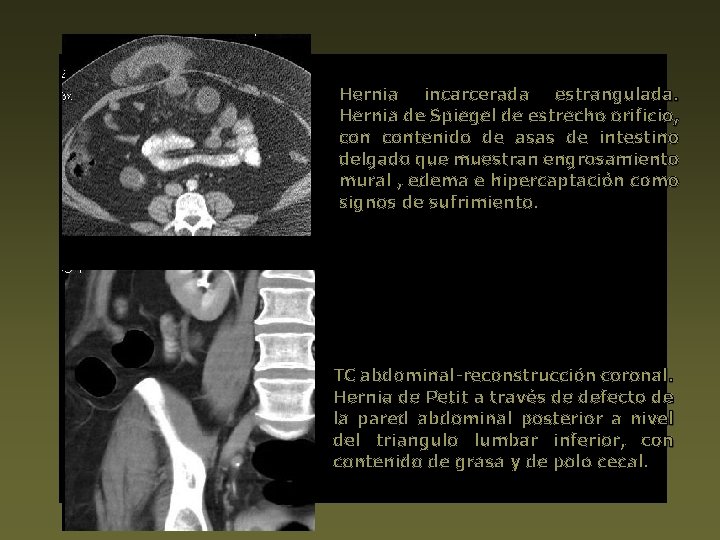 Hernia incarcerada estrangulada. Hernia de Spiegel de estrecho orificio, contenido de asas de intestino