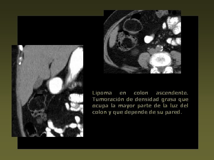 Lipoma en colon ascendente. Tumoración de densidad grasa que ocupa la mayor parte de