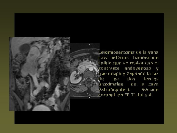 Leiomiosarcoma de la vena cava inferior. Tumoración solida que se realza con el contraste