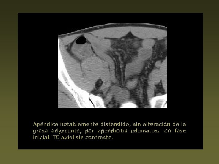 Apéndice notablemente distendido, sin alteración de la grasa adyacente, por apendicitis edematosa en fase