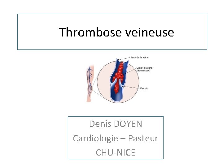 Thrombose veineuse Denis DOYEN Cardiologie – Pasteur CHU-NICE 