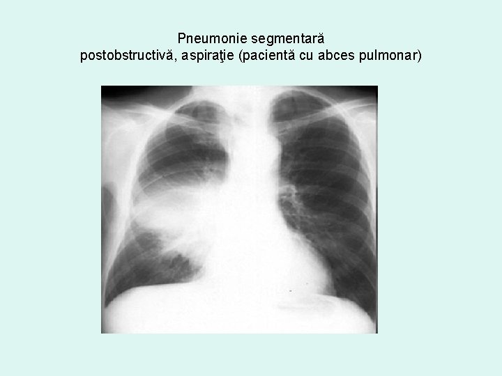aspirație pneumonie pierdere în greutate)