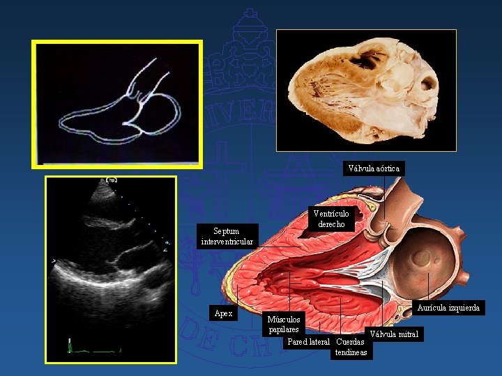 Válvula aórtica Ventrículo derecho Septum interventricular Apex Aurícula izquierda Músculos papilares Pared lateral Cuerdas