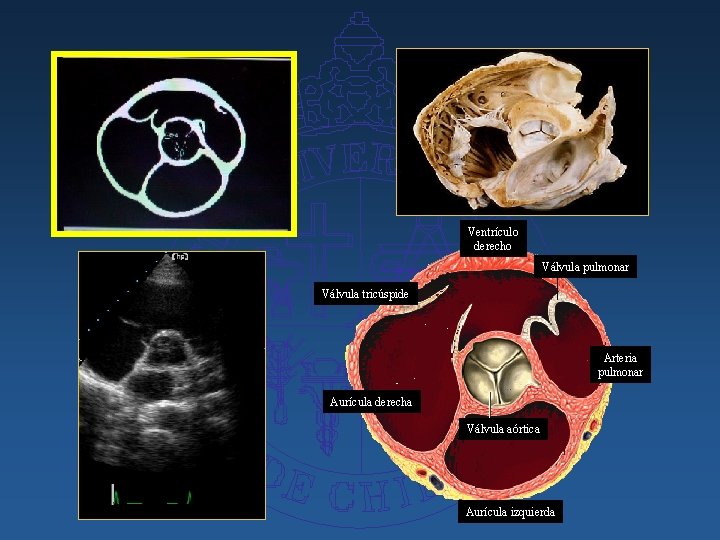 Ventrículo derecho Válvula pulmonar Válvula tricúspide Arteria pulmonar Aurícula derecha Válvula aórtica Aurícula izquierda