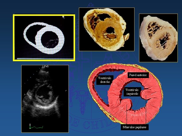 Ventrículo derecho Pared anterior Ventrículo izquierdo Músculos papilares 